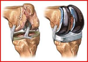 knee replacement