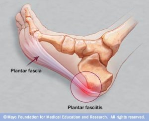 Plantar-Fasciitis-Picture
