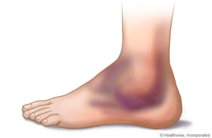 swollenankle