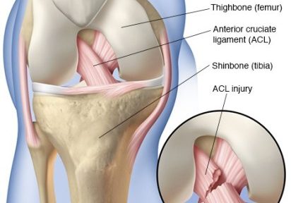 Dealing with Anterior Cruciate Ligament Injury