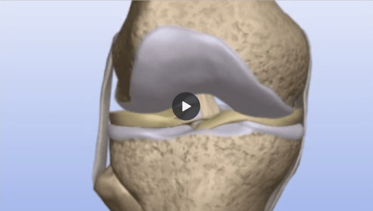 Understanding Meniscus Transplants