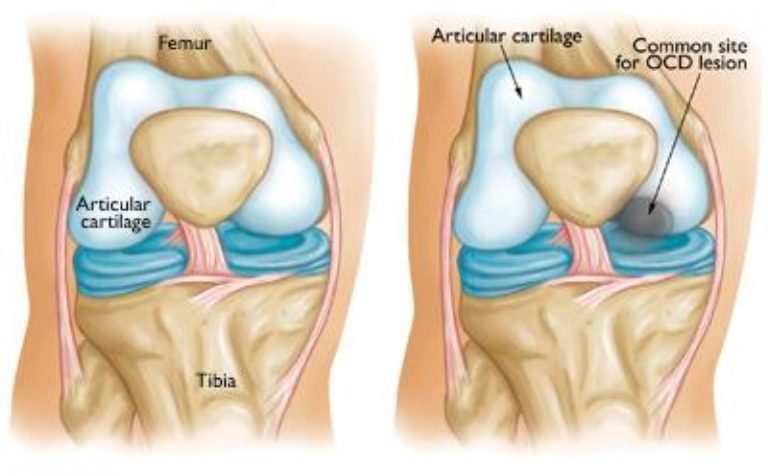 Treating Osteochondritis Dissecans