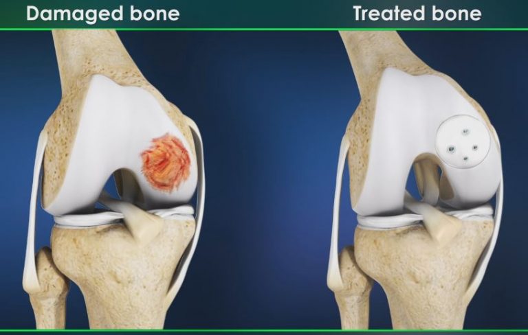 Understanding Allograft Cartilage Transplant Procedure