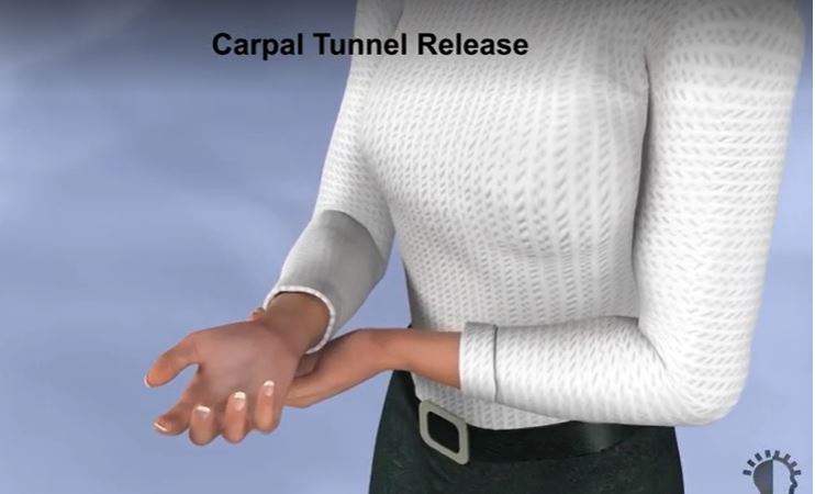UNDERSTANDING CARPAL TUNNEL RELEASE PROCEDURE