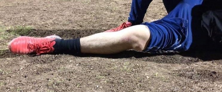 What are the signs of Kneecap Dislocation?