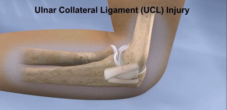 Understanding Ulnar Collateral Ligament Reconstruction-Tommy John Surgery