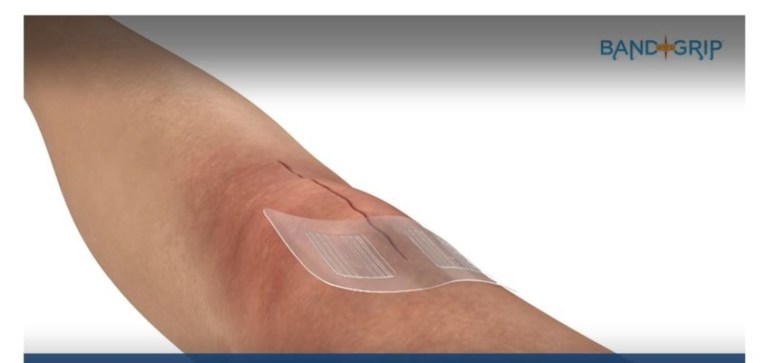 Advanced Wound Closure Technology with Fred Smith from BandGrip
