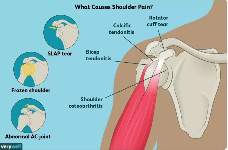 Causes of Shoulder Pain and Treatment Options