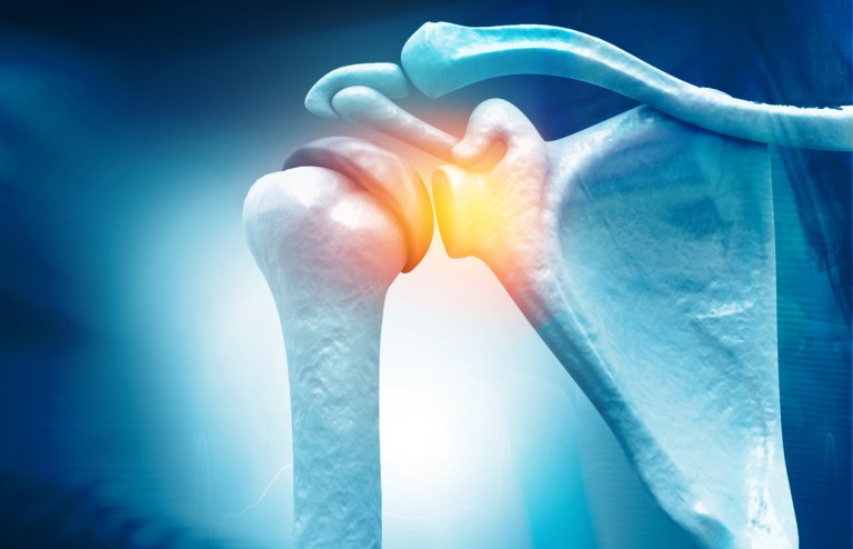 Reverse Total Shoulder Replacement: Animation Video