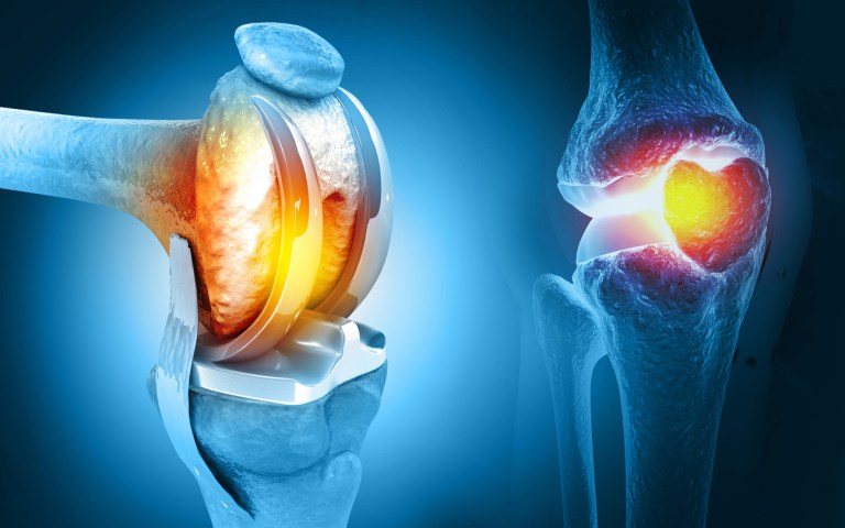 Total Knee Replacement: Animation Video