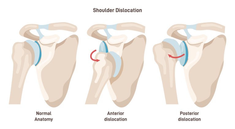 Shoulder Instability and How It’s Treated: Podcast